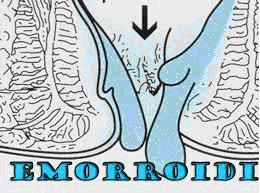 emorroidi